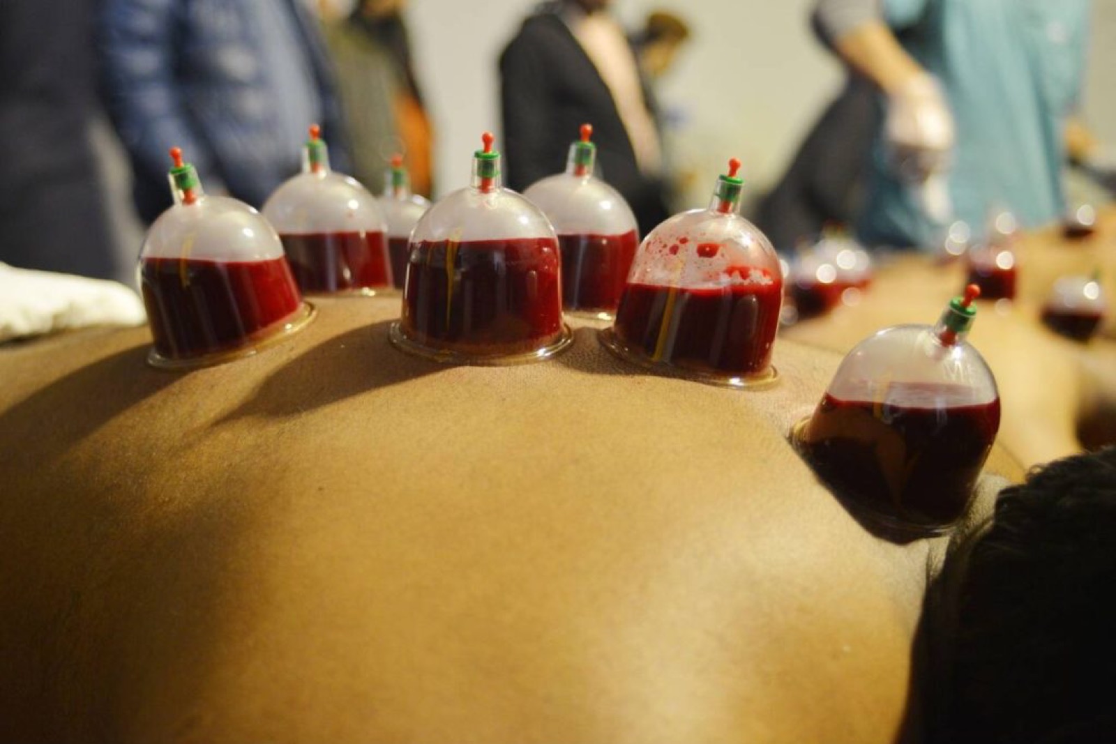 Cupping therapy cups prepared for a treatment session